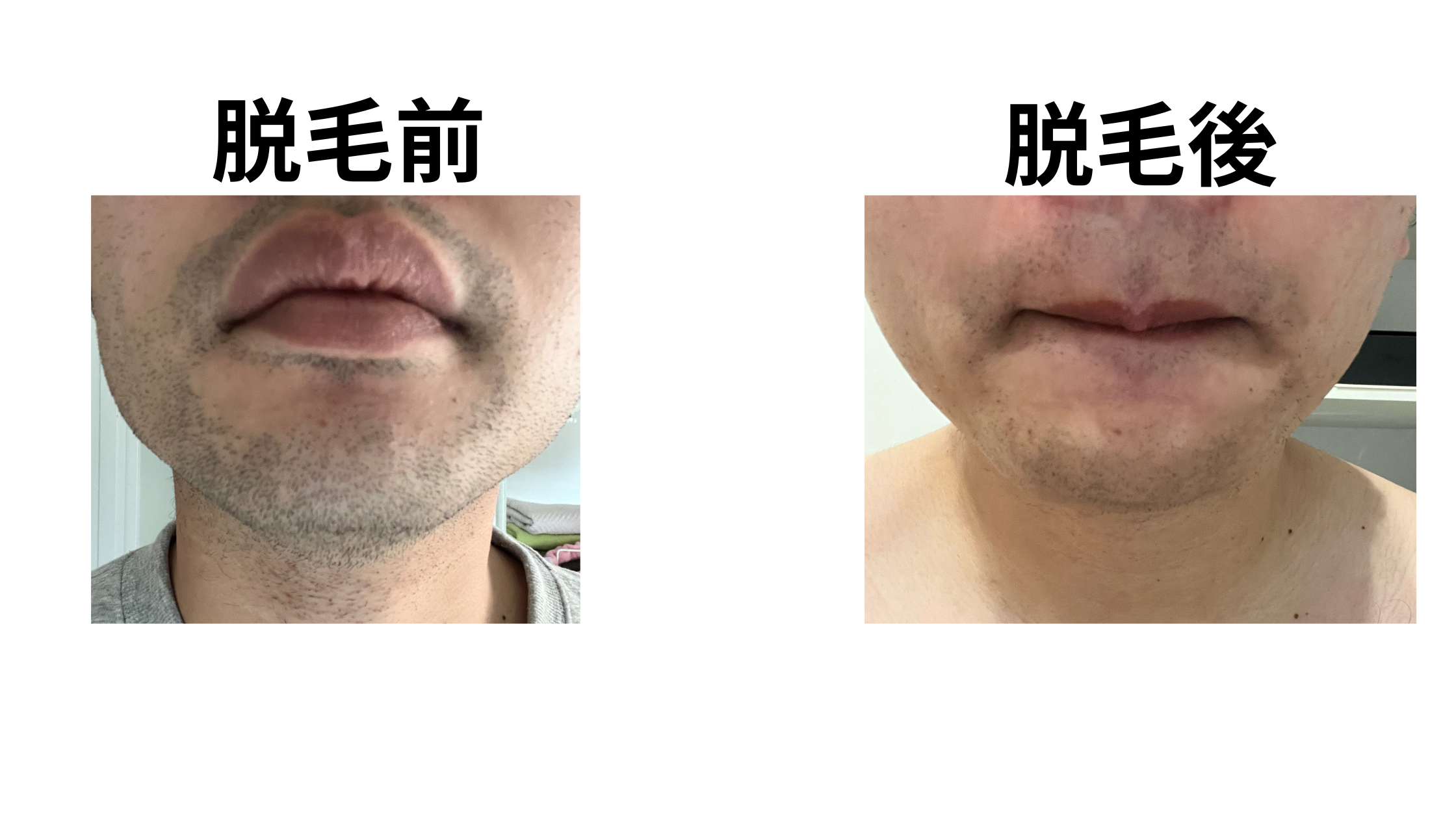 青髭ビフォーアフター